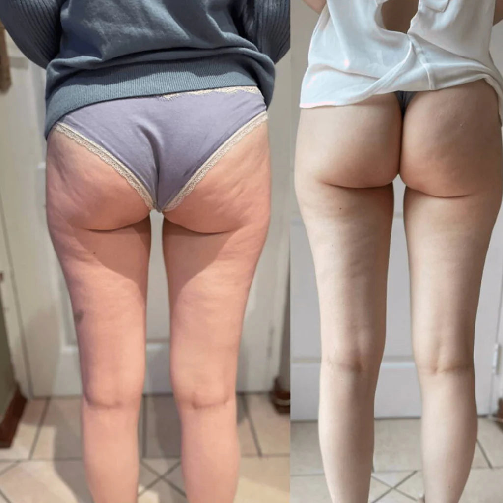 Resultado Bellavora antes y despues en piernas y gluteos