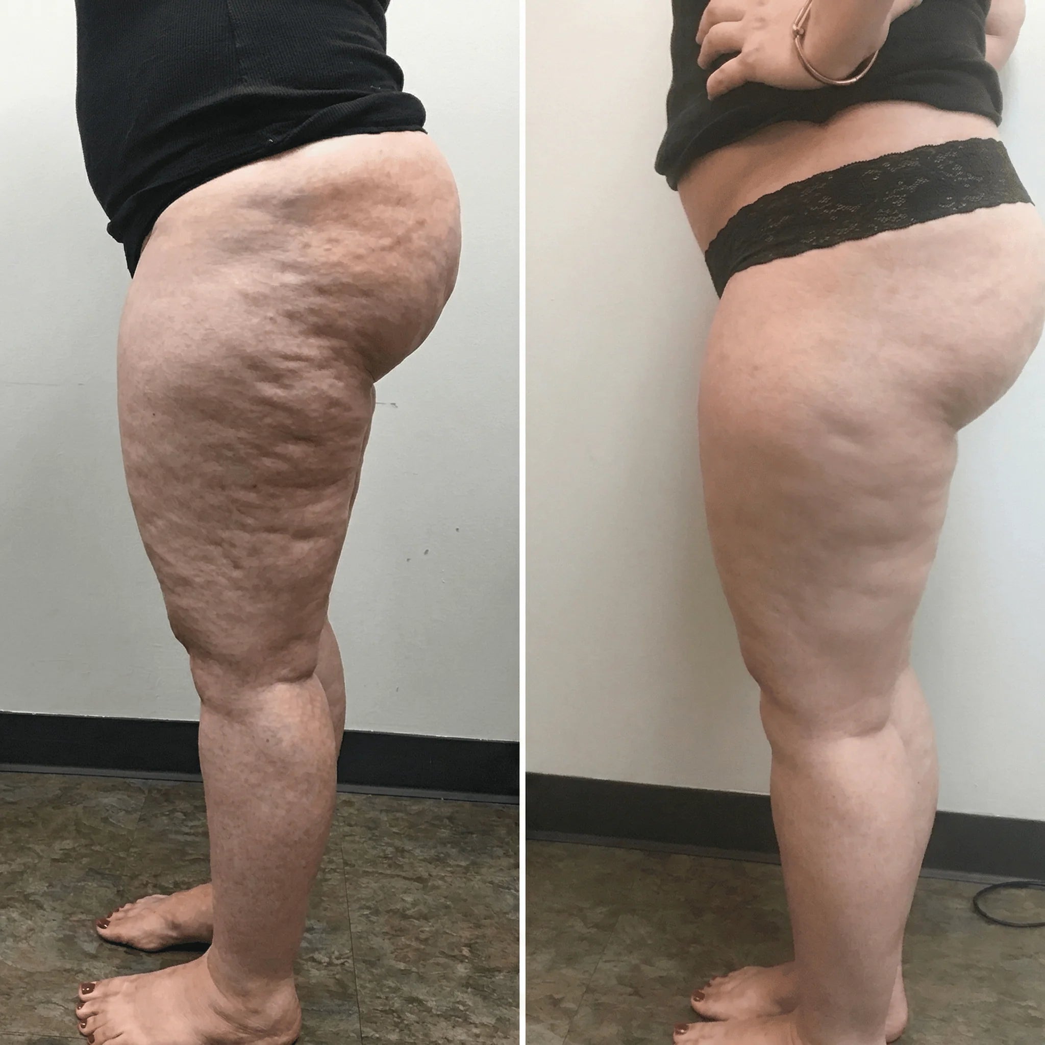 Transformacion corporal Bellavora antes y despues en piernas
