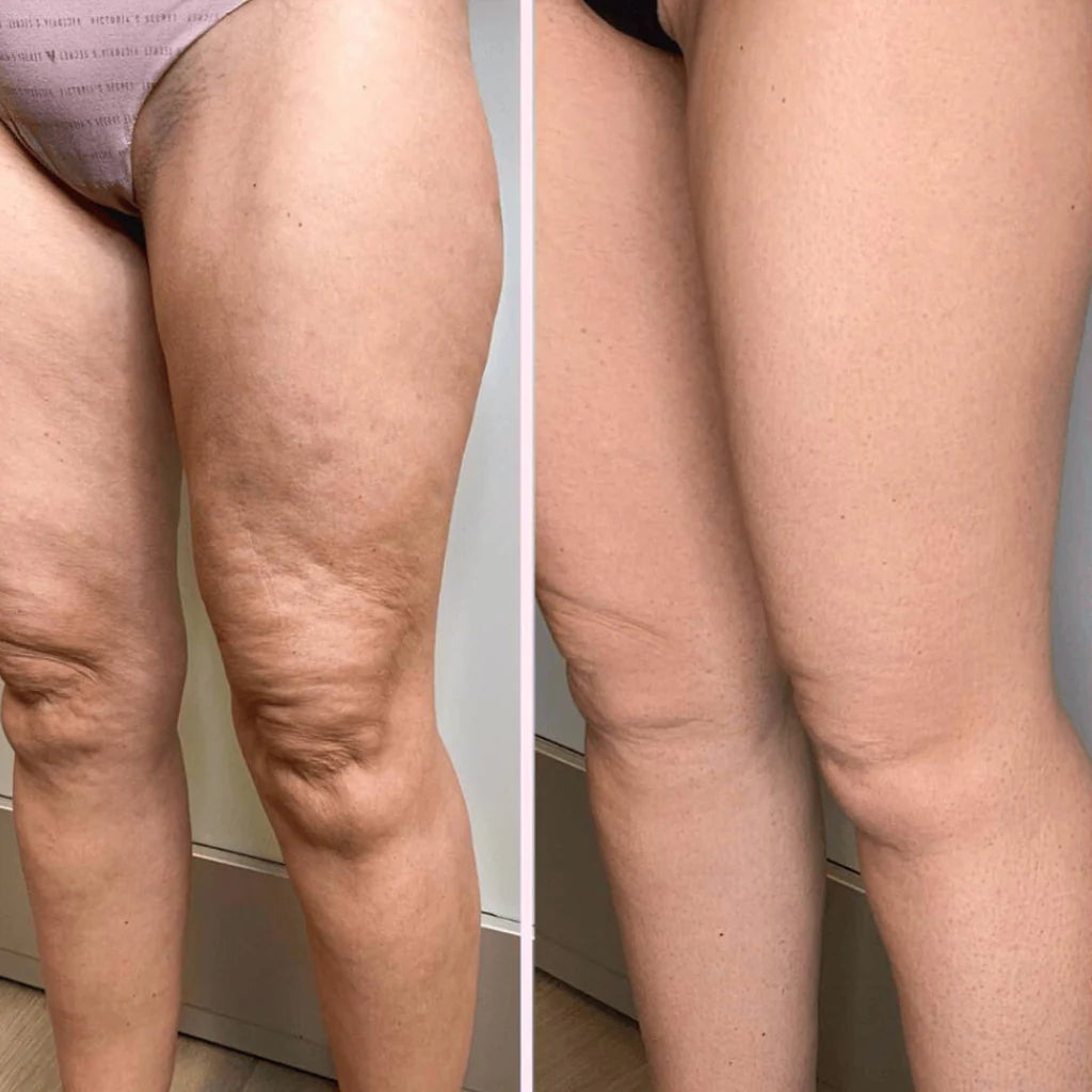 Antes y despues de rutina Bellavora para apariencia de piel mas lisa